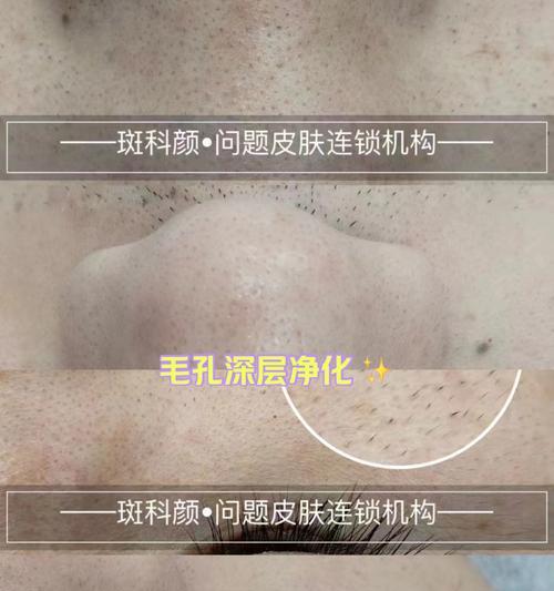 DNF毛孔净化方法是什么？如何在游戏中进行毛孔净化？